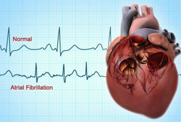 doctor_michael_jonas_israel_atrial-fibrillation-definition-treatments