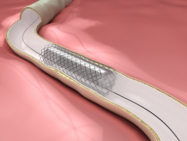 Coronary procedure – ballon with stent opening lumen artery