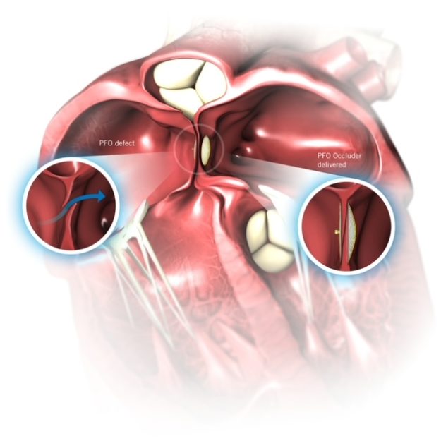 P17F06-017-01_OCC_PFO_BrochureMaterial3